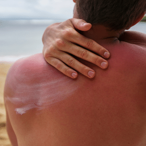 Application d'un gel apaisant après coup de soleil